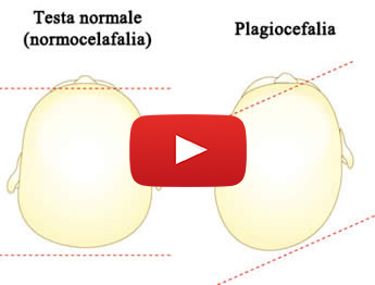 plagiocefalia copia