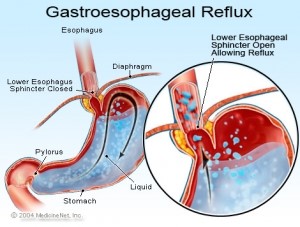 reflux